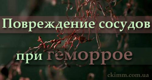 Стадии геморроя