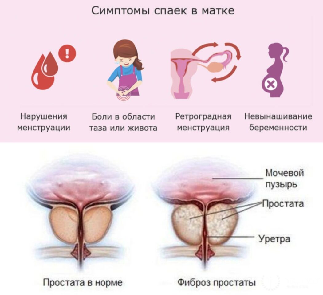 Спайки и фиброз
